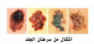 ما هو شكل سرطان الجلد